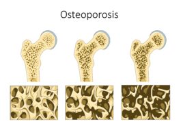 Giornata Mondiale dell\'osteoporosi 2025