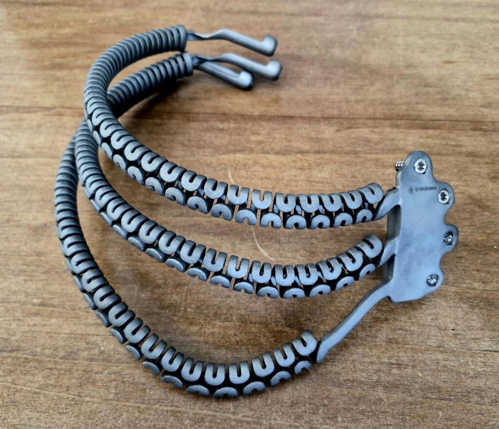 Ricostruzione innovativa della parete toracica attraverso una protesi su misura in titanio stampata in 3D