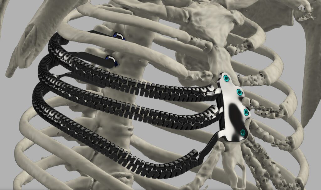 Ricostruzione innovativa della parete toracica attraverso una protesi su misura in titanio stampata in 3D